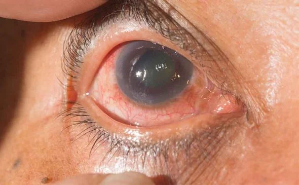 Glaucoma patient
